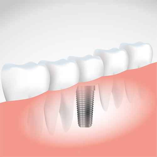 IMPLANTES DENTAIS SÃO ALTERNATIVAS A DENTES AUSENTES OU PRÓTESES